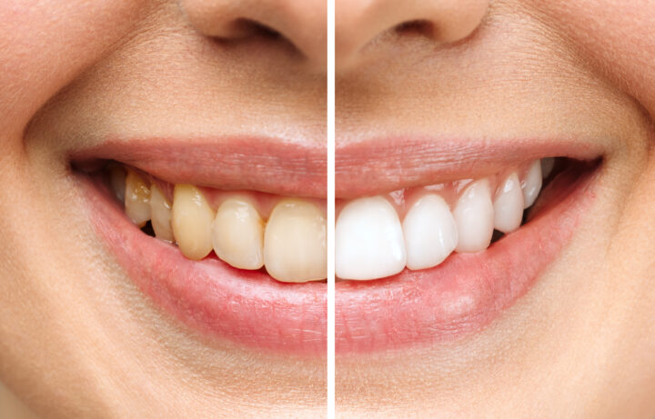 woman-teeth-before-after-whitening-white-background-dental-clinic-patient-image-symbolizes-scaled