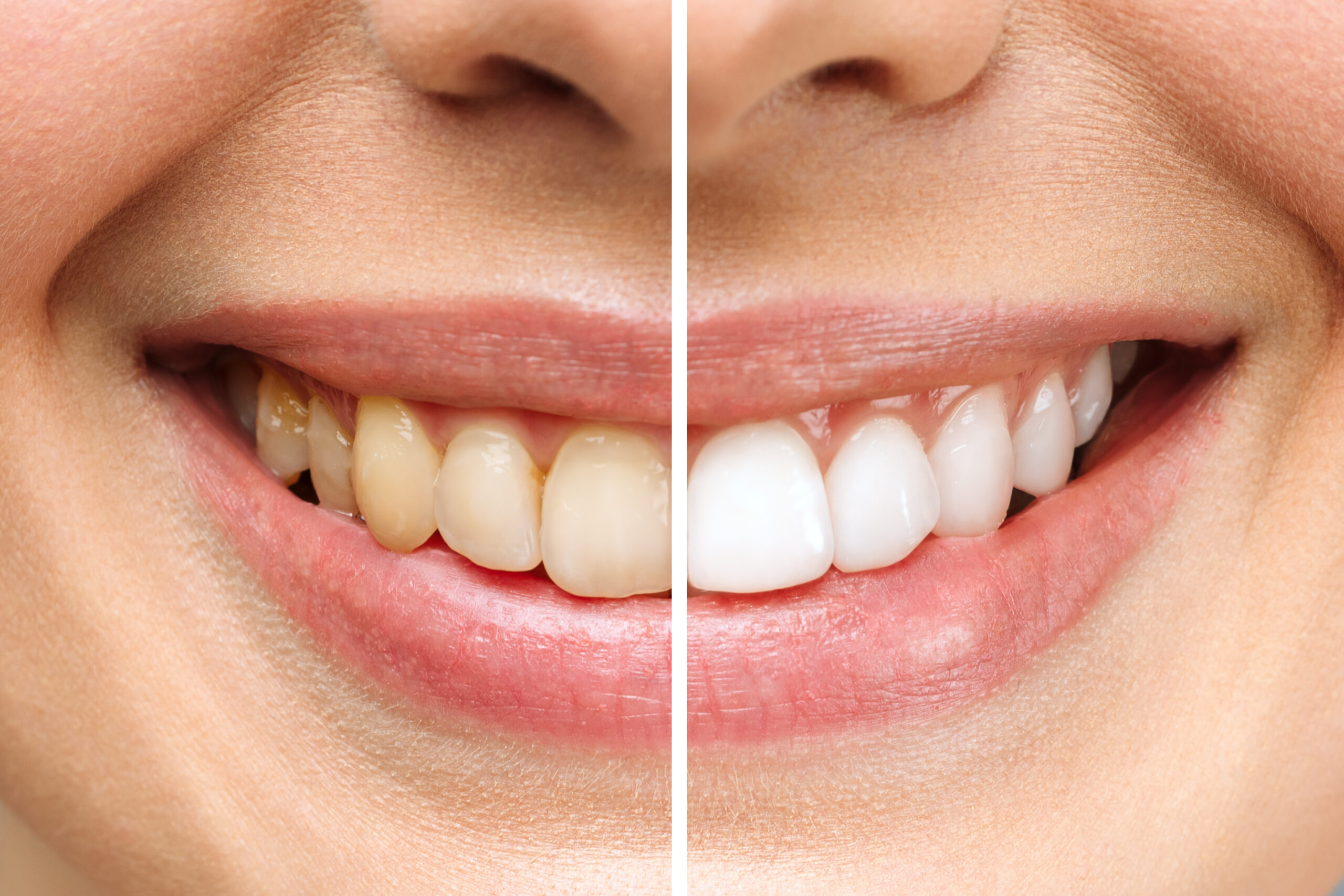 woman-teeth-before-after-whitening-white-background-dental-clinic-patient-image-symbolizes-scaled